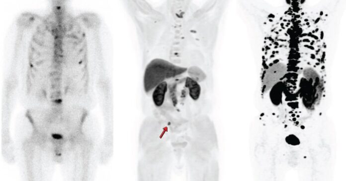 PET-CT com PSMA: revolução no diagnóstico e tratamento do câncer de próstata
